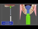 Kit d'approche crestale pour sinus (CASKIT)(HCRSNK) HIOSSEN-OSSTEM - DELYNOV