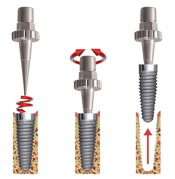 Kit de 2 extracteurs courts de diamètre 4 mm - Acteon (300.56) - Delynov